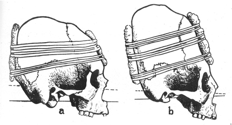 A head binding method and skulls recovered from ancient graves showing the effects of head binding in infancy.
